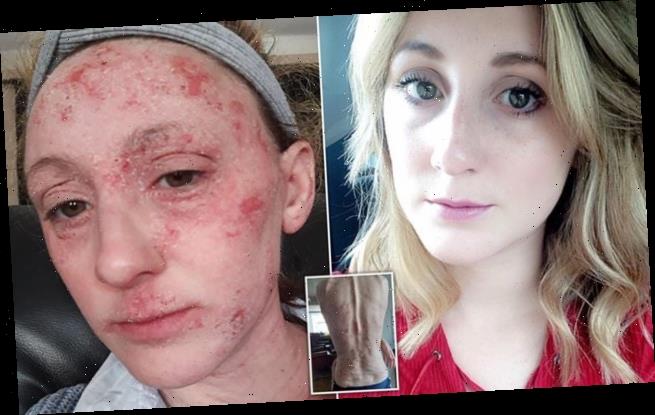 Woman with severe eczema claims doctors laugh at her