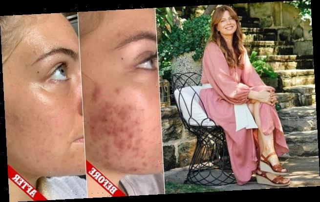 How young woman with cystic acne cleared her skin for good