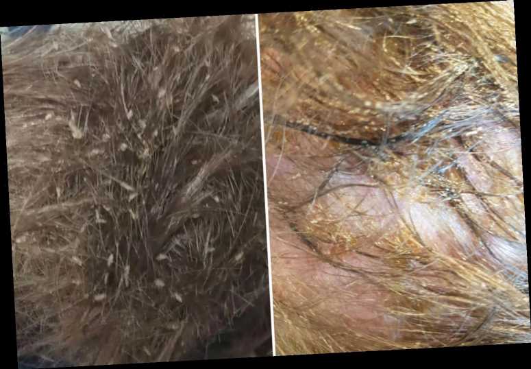 Experts show 'worst ever' cases of nits which plagued kids for over a year & beg parents to check before schools return