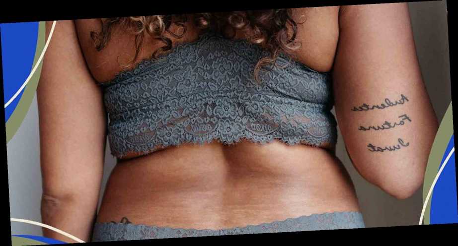 Stretch Marks Happen. Why Do Women Have to Love Them, Too?