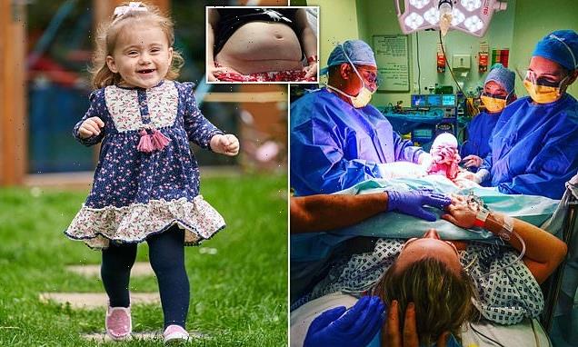 Girl, two, who had spinal surgery in womb beats odds to walk