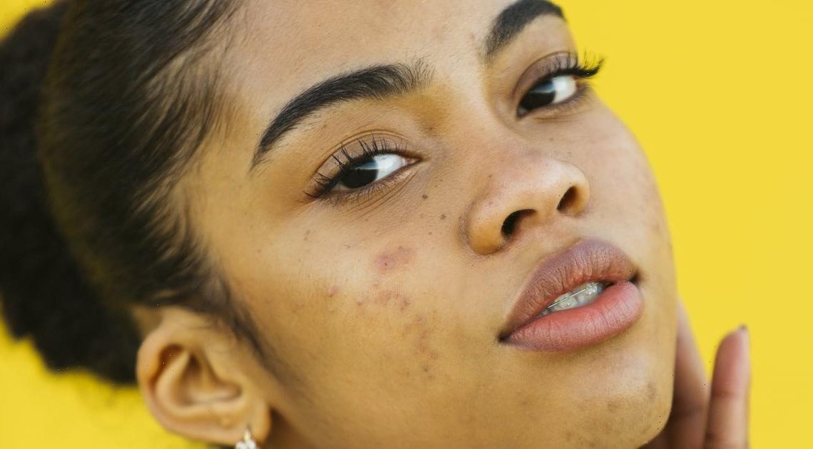 How to Determine What Type of Acne You Have, so You Can Better Treat It