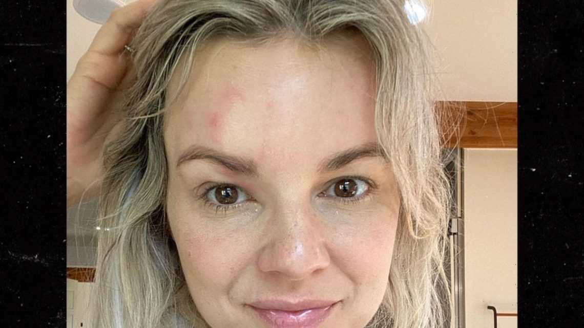 'Bachelorette' Ali Fedotowsky Reveals She Has Shingles at 36 Years Old