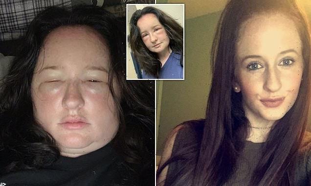 Woman, 26, reveals allergic reaction left her with chemical burns
