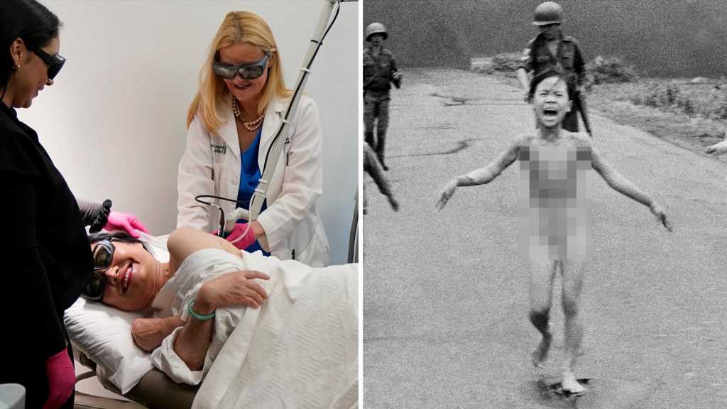 Kim Phuc, Vietnam War 'Napalm Girl,' Gets Final Burn Treatment 50 Years Later
