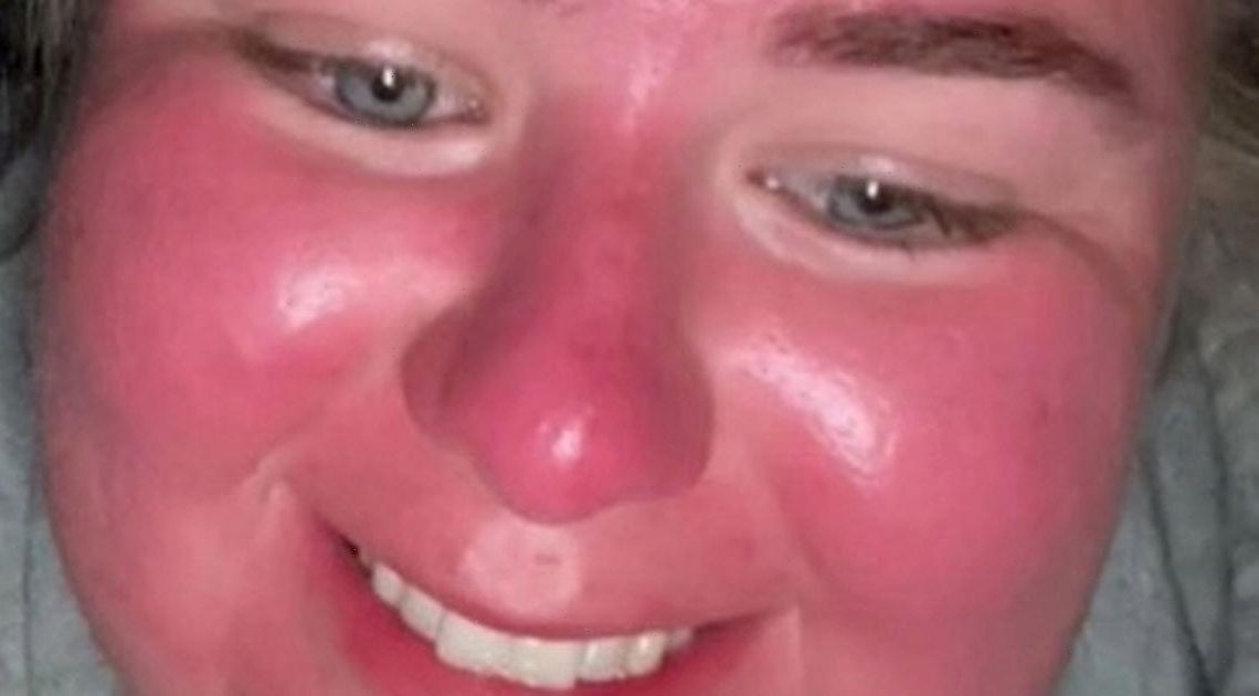 ‘I went out to tan for an hour – now I’ve got blisters on my red, swollen face’
