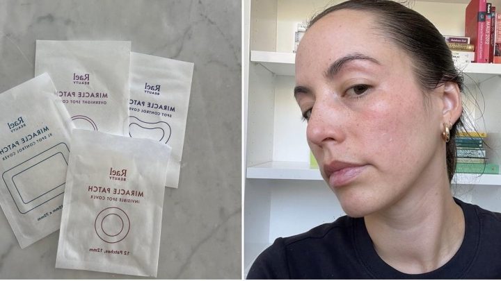 I Finally Found Pimple Patches That Actually Work For Me