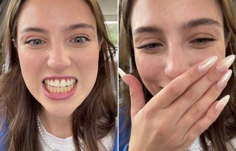Woman only whitens her top teeth as she doesn’t have trays for the bottom and is stunned with how things go | The Sun