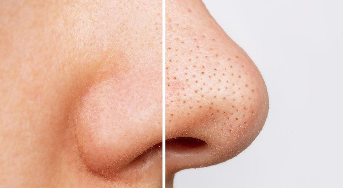 Pores: Unclogged! This Silver Blackhead Powder Is Just $12