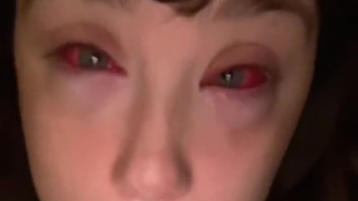 Woman issues warning after claiming cheap Shein lashes left with her red blood eyes which took over a month to heal | The Sun