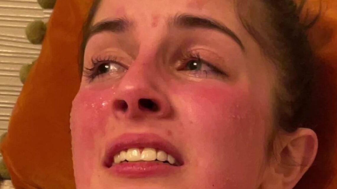 Woman who is &apos;allergic to herself&apos; her skin breaks out if she laughs